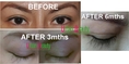 www.urbanbeautythailand.com - Save Your Eyes With An Eyelash Transplant Bangkok, Thailand!