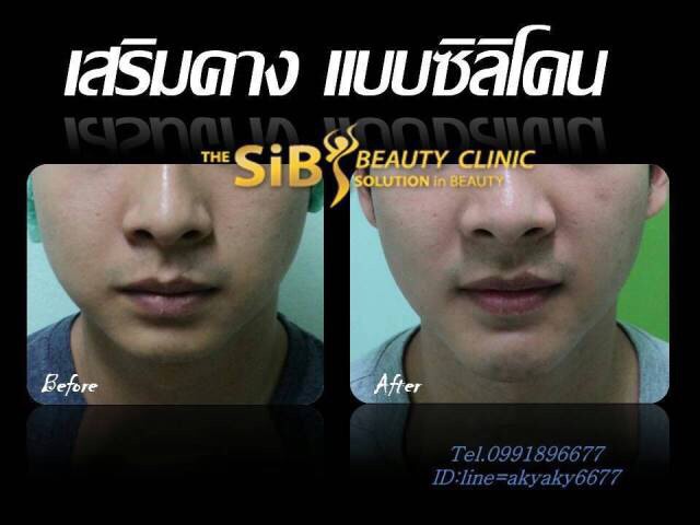 เสริมคางสไตล์เกาหลี by.thesib clinic รูปที่ 2