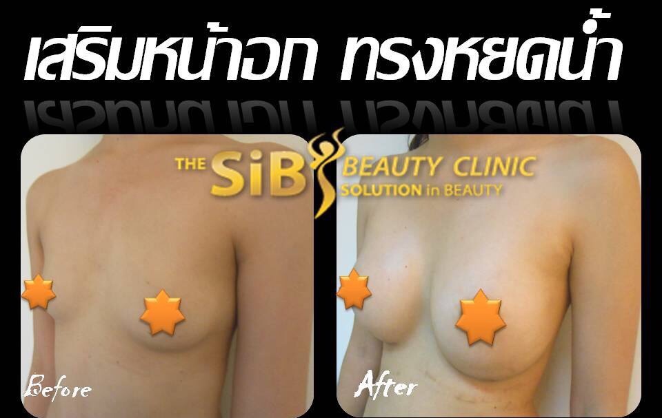 เสริมหน้าอกผ่านกล้องลด30เปอร์เซ็นต์ ที่thesib clinic รูปที่ 6