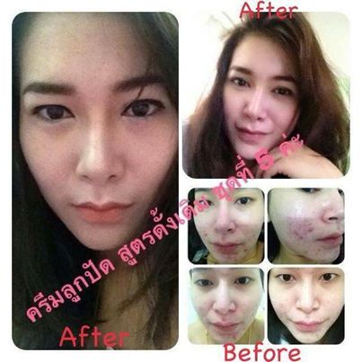 ครีมลูกปัดแพคเก็จใหม่ ครีมหน้าขาวใส ไร้สิว ฝ้า-กระ จุดด่างดำหายเกลี้ยง รีวิวล้นหลามจร้าา รูปที่ 5