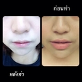 ปากกระจับ ปากบาง หมอดารินทรื ราคา