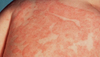 รูปย่อ จำหน่ายสารสกัดจากสมุนไพรธรรมชาติ ป้องกันและรักษาผิวหนังอักเสบ ตุ่มคันและผื่นแพ้ผิวหนัง(Eczema,Atopic Dermatitis) รูปที่2