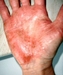รูปย่อ จำหน่ายสารสังเคราะห์จากธรรมชาติป้องกันและรักษาอาการผิวหนังอักเสบตุ่มคันแบบใส(Dyshidrosis Dermatitis ) รูปที่4