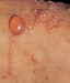 รูปย่อ จำหน่ายสารสังเคราะห์จากธรรมชาติป้องกันและรักษาอาการผิวหนังอักเสบตุ่มคันแบบใส(Dyshidrosis Dermatitis ) รูปที่7