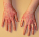 รูปย่อ จำหน่ายสารสังเคราะห์จากธรรมชาติป้องกันและรักษาอาการผิวหนังอักเสบตุ่มคันแบบใส(Dyshidrosis Dermatitis ) รูปที่2