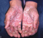 รูปย่อ จำหน่ายสารสังเคราะห์จากธรรมชาติป้องกันและรักษาอาการผิวหนังอักเสบตุ่มคันแบบใส(Dyshidrosis Dermatitis ) รูปที่5
