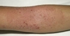 รูปย่อ จำหน่ายสารสกัดจากสมุนไพรธรรมชาติ ป้องกันและรักษาผิวหนังอักเสบ ตุ่มคันและผื่นแพ้ผิวหนัง(Eczema,Atopic Dermatitis) รูปที่5