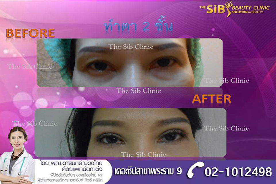 ตาสองชั้น  สวยกลมโต By The sib clinic rama 9 ชั้น 5 รูปที่ 1