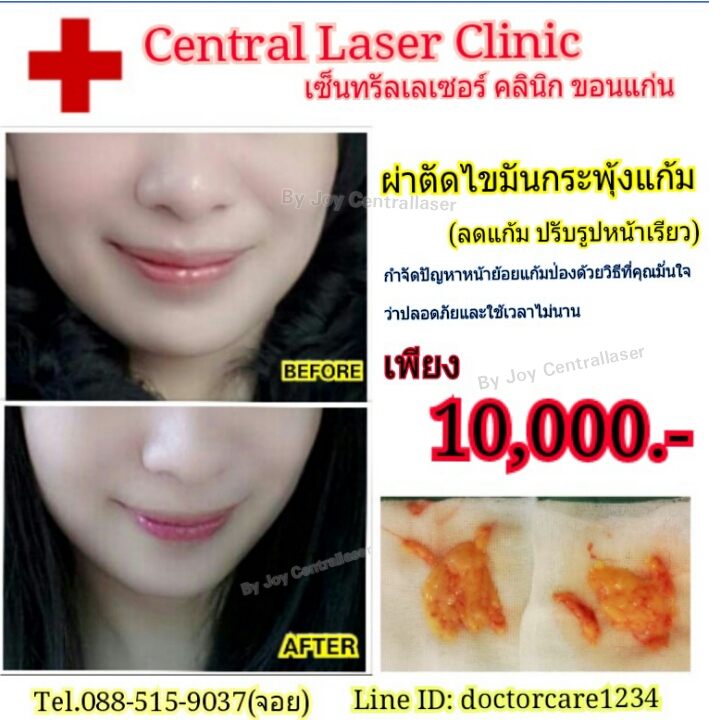 ผ่าตัดไขมันกระพุ้งแก้ม  เพียง 10,000 บาท By เซ็นทรัลเลเซอร์ คลินิก ขอนแก่น รูปที่ 1