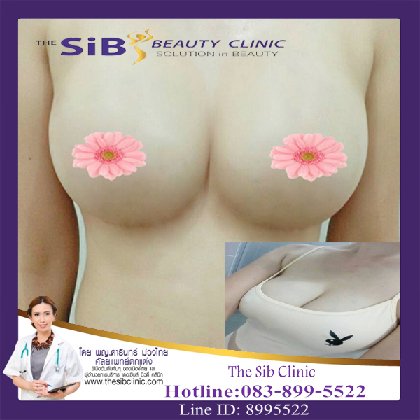 รีวิวเสริมหน้าอกชิดและ สวย ๆๆ โดยแพทย์หญิงดารินทร์ ม่วงไทย The sib clinic รูปที่ 1