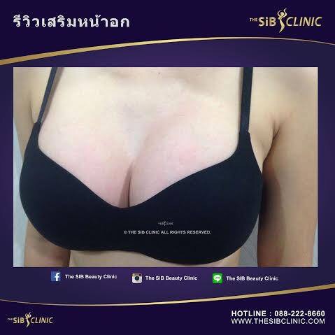 เสริมหน้าอก หมอดารินทร์ Thesib รูปที่ 1