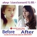 รูปย่อ ราคาเสริมจมูก เซ็นทรัลเลเซอร์คลินิก ขอนแก่น รูปที่6