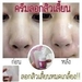 รูปย่อ ครีมลอกสิวเสี้ยน ขั้นเทพ สูตรเวียดนาม รูปที่7