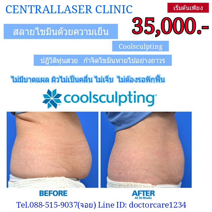 กำจัดไขมันถาวร Coolsculpting ที่เซ็นทรัลเลเซอร์คลินิกขอนแก่น รูปที่ 1