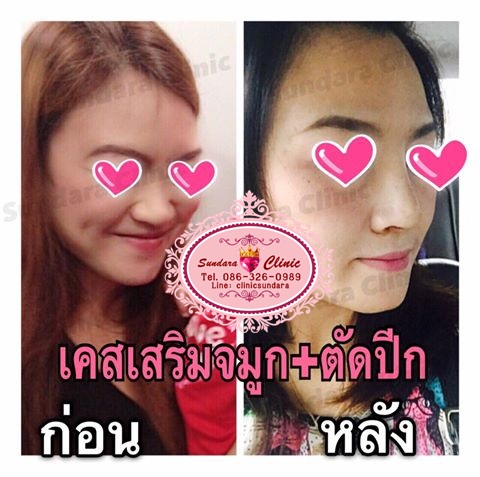 โปรเสริมจมูก 15,000บาท รูปที่ 4