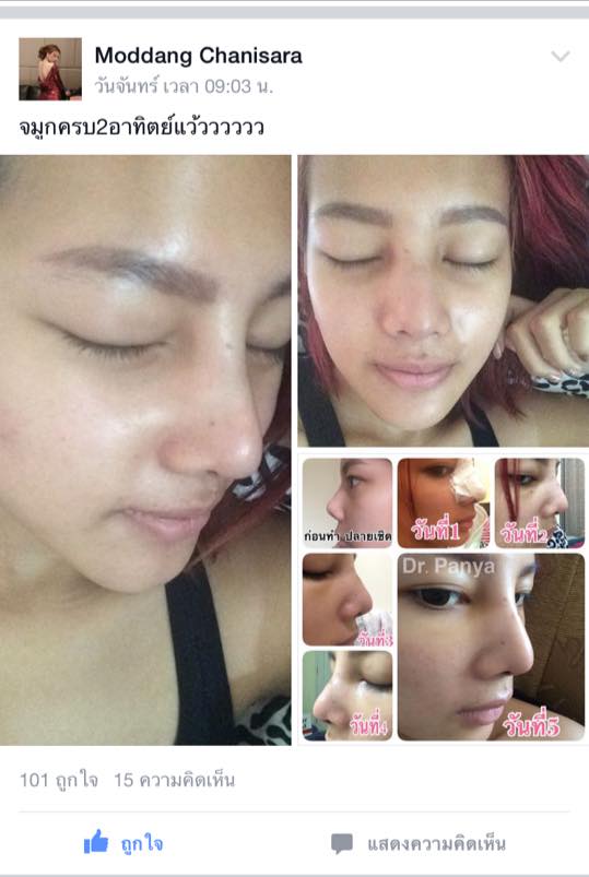 โปรเสริมจมูก 15,000บาท รูปที่ 3