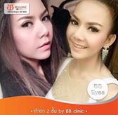 เสริมหน้าอก ซิลิโคนอเมริกา bb clinic ราคาพิเศษ ติดต่อคุณแมว 0653545163 รูปที่ 4