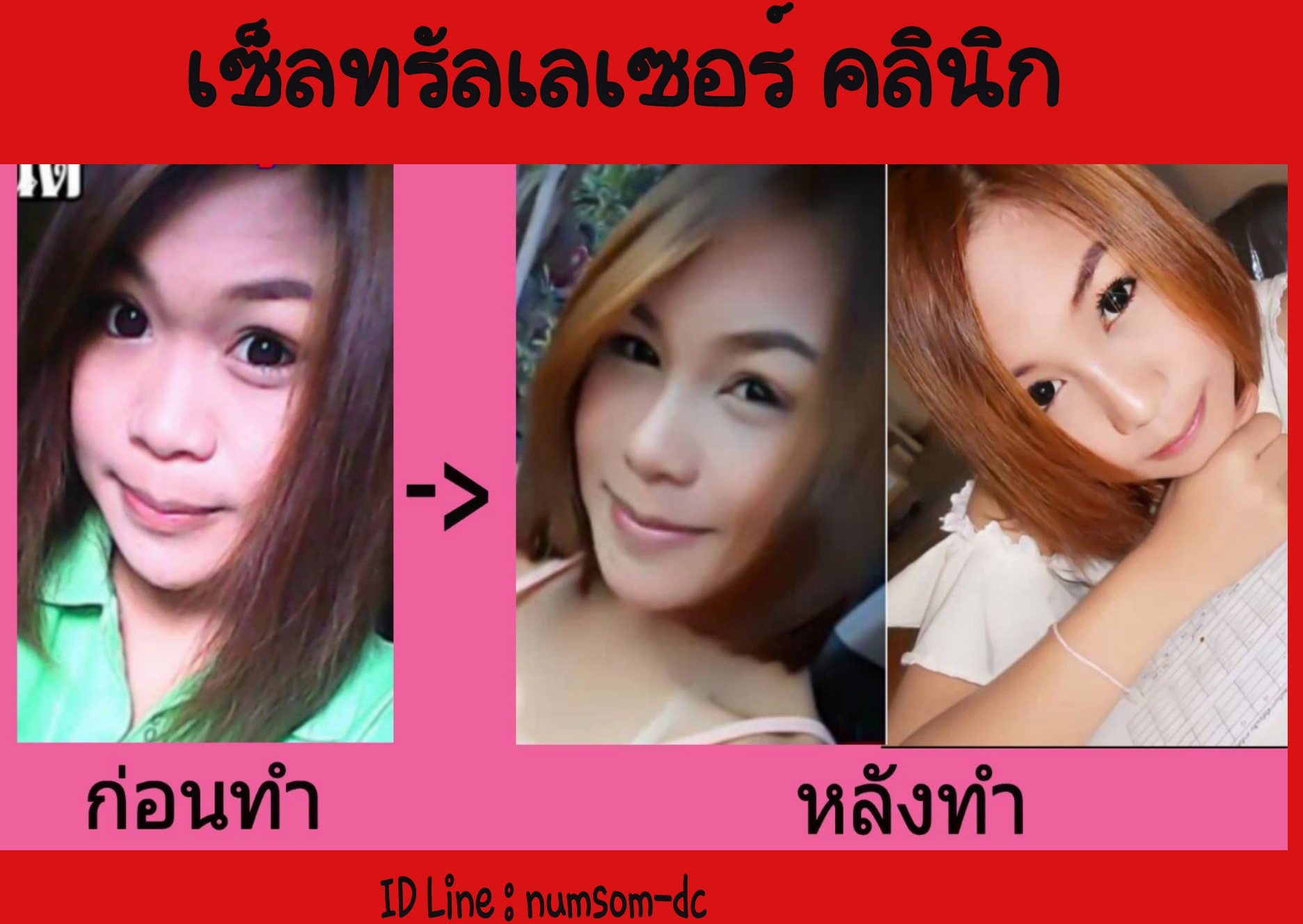 เสริมจมูกเซ็นทรัลเลเซอร์คลินิกขอนแก่น รูปที่ 1