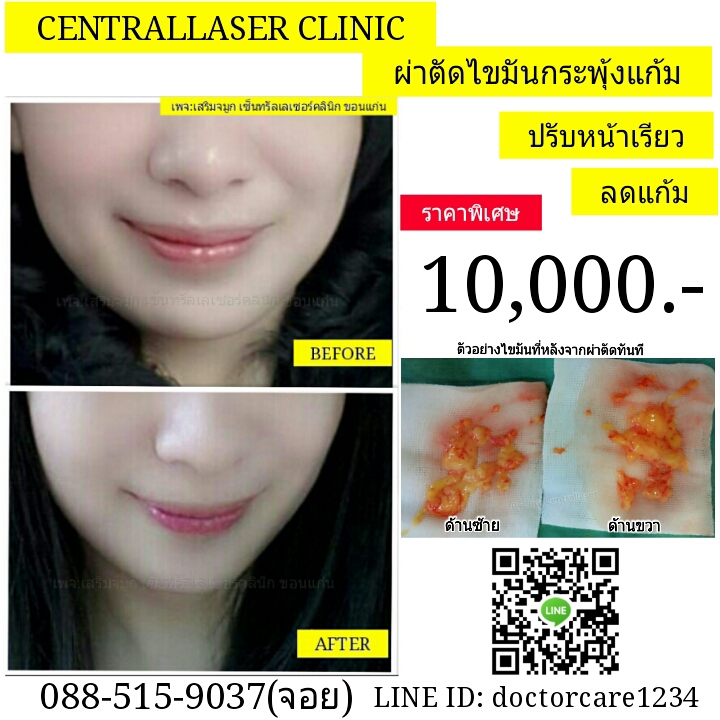 ผ่าตัดไขมันกระพุ้งแก้ม10,000บาท ที่นี่เซ็นทรัลเลเซอร์คลินิก รูปที่ 1