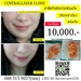 รูปย่อ ผ่าตัดไขมันกระพุ้งแก้ม10,000บาท ที่นี่เซ็นทรัลเลเซอร์คลินิก รูปที่1