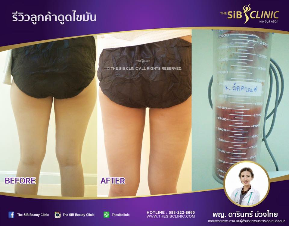 หมอดารินทร์ดูดไขมัน รูปที่ 1