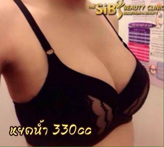 เสริมหน้าทรงกลม ทรงหยดน้ำ กับหมอดารินทร์ รูปที่ 1