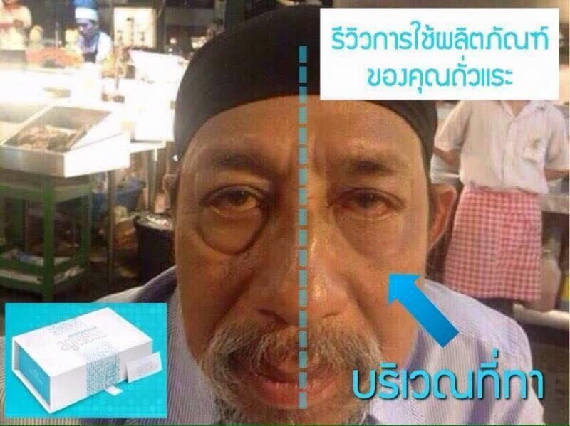 แก้ปัญหาถุงใต้ตา ริ้วรอย ตีนกา รูปที่ 1