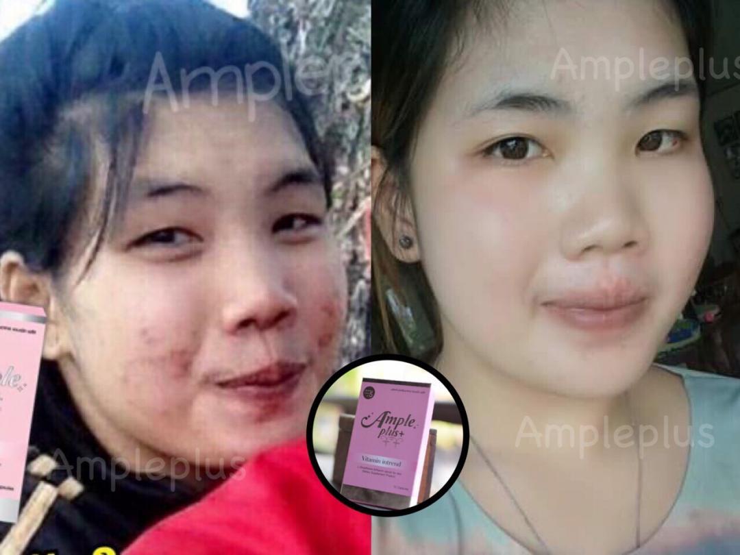 Ample ขาวผ่อง วิตามินต้านแดด ตัวแทนบางนา รูปที่ 6