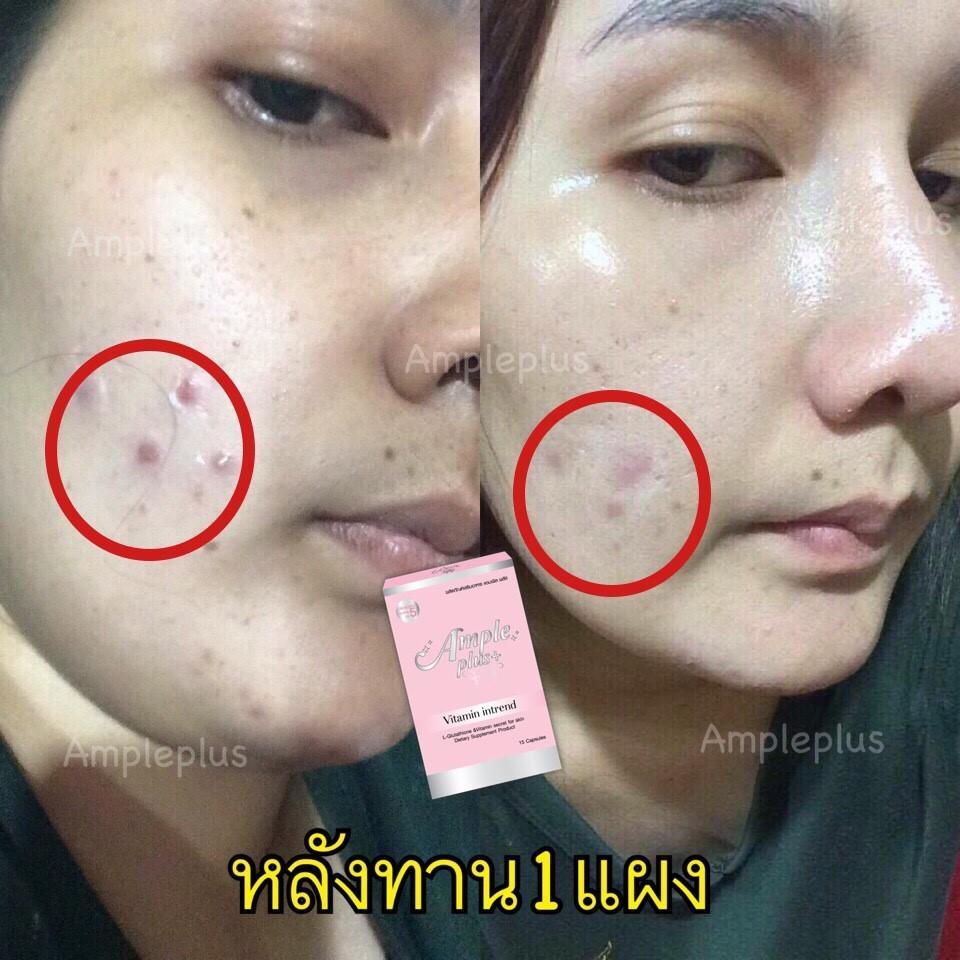 Ample ขาวผ่อง วิตามินต้านแดด ตัวแทนบางนา รูปที่ 3