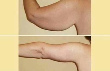 LUMINESCE ESSENTIAL BODY RENEWAL แขน ขาคุณจะเรียวเล็ก แบบไม่ต้องเจ็บตัว รูปที่ 3