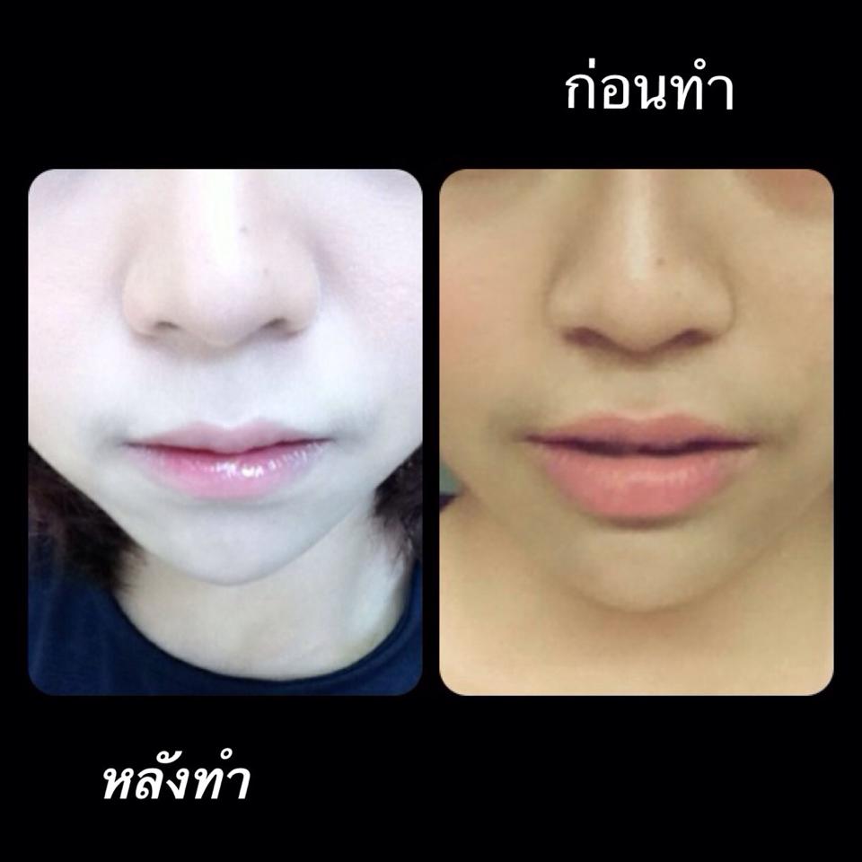 ทำปากบาง ปากกระจับ  หมอดารินทร์ 0924414623 รูปที่ 1