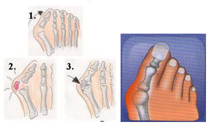  	Silicone Gel สำหรับท่านที่มีปัญหาเรื่องกระดูกนิ้วหัวแม่เท้า กระดูกคด ไม่ตรง กระดูกโปน นิ้วเท้าซ้อนกัน  รูปที่ 1