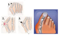  	Silicone Gel สำหรับท่านที่มีปัญหาเรื่องกระดูกนิ้วหัวแม่เท้า กระดูกคด ไม่ตรง กระดูกโปน นิ้วเท้าซ้อนกัน 