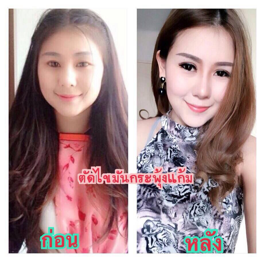 ผ่าตัดไขมั้นกระพุ้งแก้ม thesib clinic รูปที่ 1