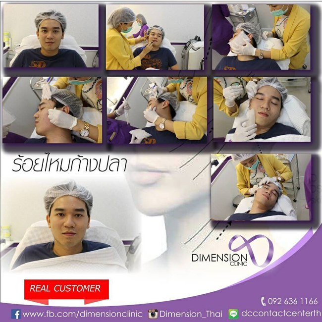 ร้อยไหมก้างปลา Twist ทองหล่อ ร้อยไหมปรับรูปหน้าที่ Dimension Clinic แป๊ะจริง รูปที่ 4