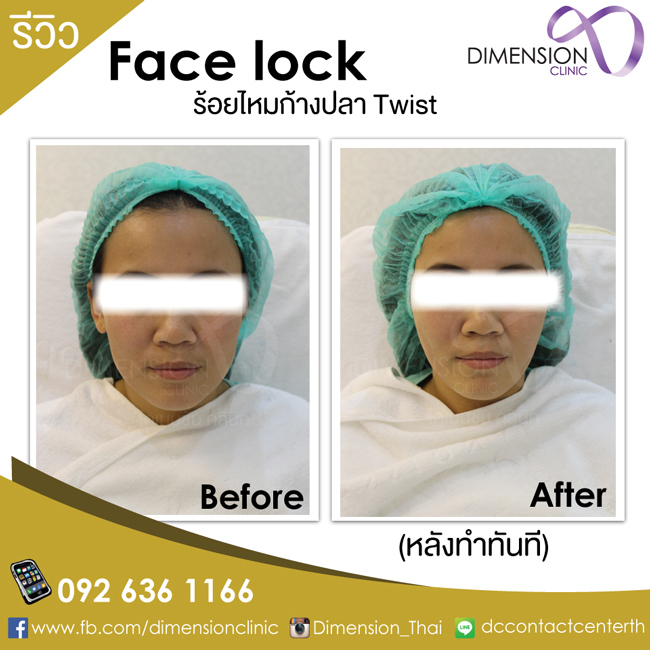 ร้อยไหมก้างปลาTwist Promotion คุณหมอเบนซ์ โปรโมชั่นร้อยไหมก้างปลา ไดเมนชั่นคลีนิก รูปที่ 6