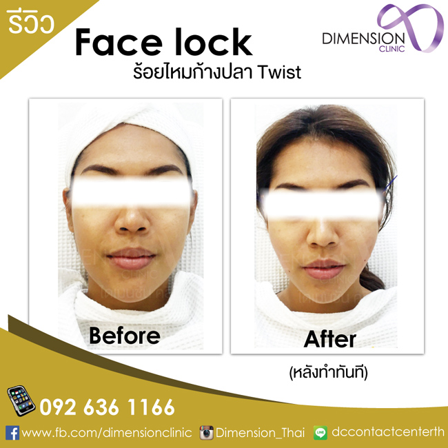 ร้อยไหมก้างปลาTwist Promotion คุณหมอเบนซ์ โปรโมชั่นร้อยไหมก้างปลา ไดเมนชั่นคลีนิก รูปที่ 10