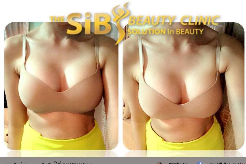 แนะนำคลินิกเสริมหน้าอก ด้วยศัลยแพทย์หญิง Thesib clinic จอง 0924414623 รูปที่ 1