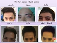 รีวิวทำตา คุณหมอดารินทร์ thesib clinic