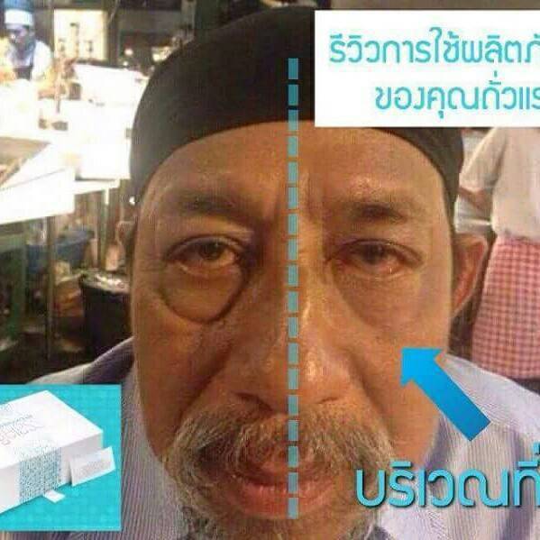 ลดริ้วรอย ถุงใต้ตา ตีนกา รูปที่ 1