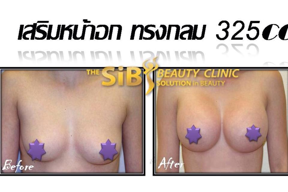 เสริมหน้าอกยอดนิยม กับ หมอดารินทร์ ราคาพิเศษ 0924414623 รูปที่ 1