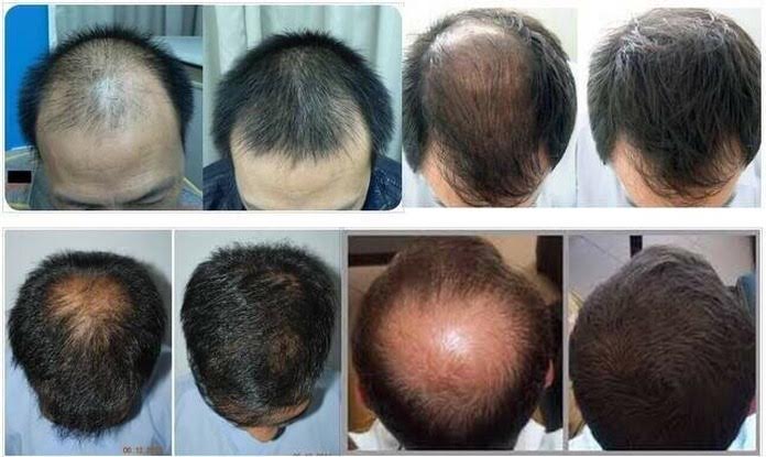 เซรั่มปลูกผมและแชมพู SAMORN แก้ปัญหาผมร่วง ผมบาง รูปที่ 6