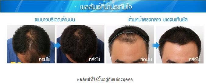 เซรั่มปลูกผมและแชมพู SAMORN แก้ปัญหาผมร่วง ผมบาง รูปที่ 5
