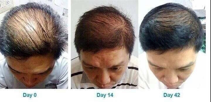 เซรั่มปลูกผมและแชมพู SAMORN แก้ปัญหาผมร่วง ผมบาง รูปที่ 7