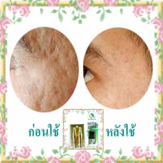ชุดหลุมสิวเร่งด่วน หลุมสิวตื้นขึ้นสำหรับคนเป็นหลุมสิวมานาน เป็นลึกและมีลักษณะผิวมะกรูด  รูปที่ 8