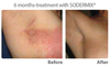 รูปย่อ SODERMIX Anti-inflammatory Cream ครีมทาแผลเป็น แก้อักเสบและอาการคัน รูปที่3