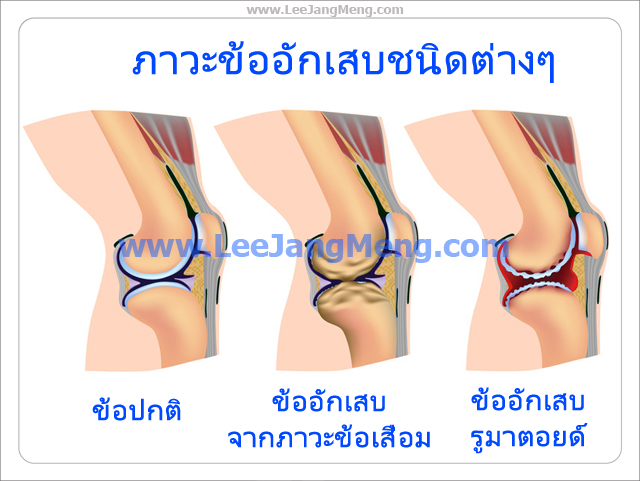 ปวดเข่่า ดูแลอย่างไร รูปที่ 3