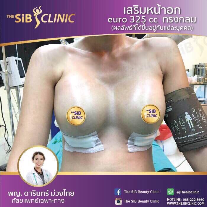 เสริมหน้าอกทรงกลมหลังจากผ่าเสร็จทันที0924414623 รูปที่ 1