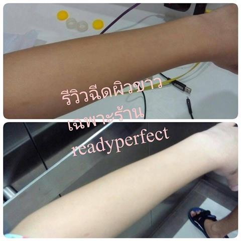 Readyperfect Medical Center ฉีดกลูต้า ฉีดผิวขาว โบท็อก เมโสแฟต ราคาถูกที่สุด รูปที่ 7