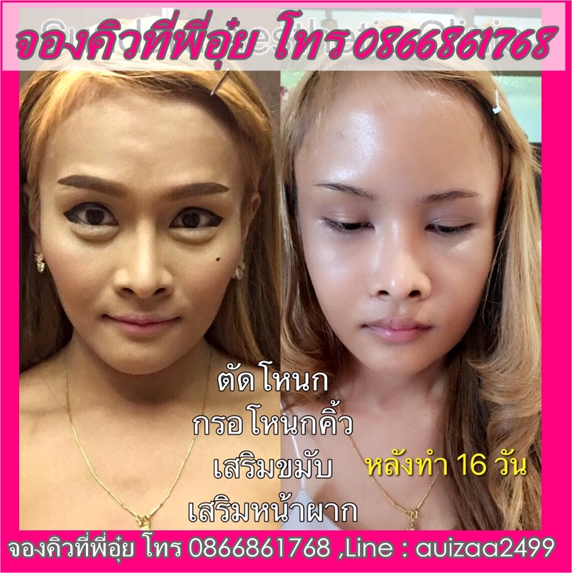 ทุบโหนกตัดกรามอาจารย์หมอปัญญา รูปที่ 3